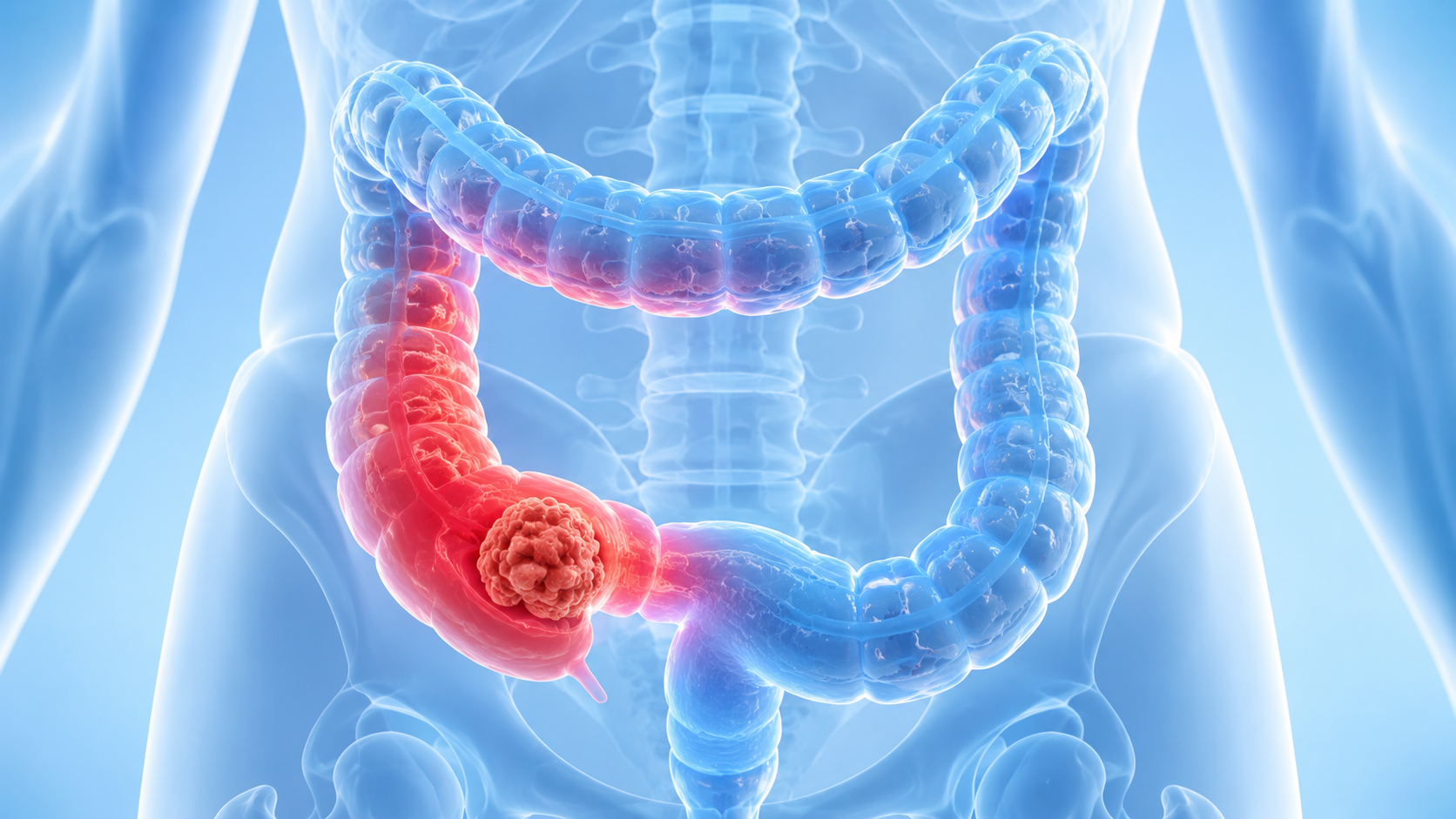 Colorectal Cancer Treatment Guide